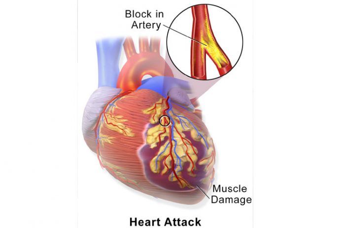 Cardiopatia Mixta Isquemica E Hipertensiva Pdf