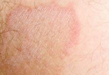 rid cancer skin jock itch signs early