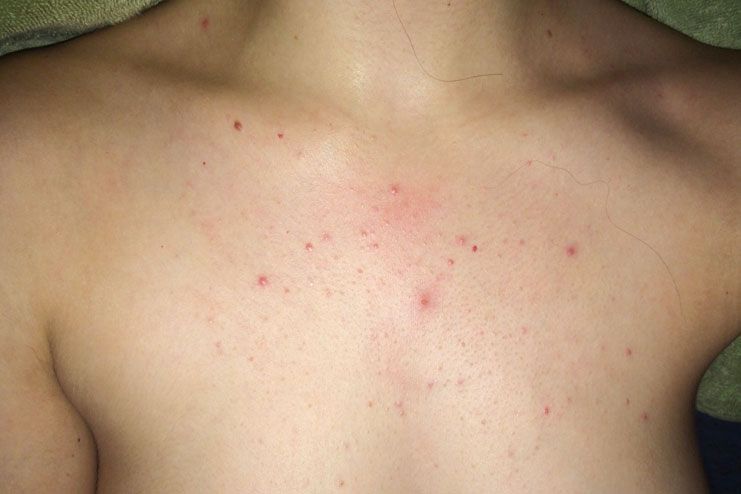 Chest Acne Causes Treatment And Prevention