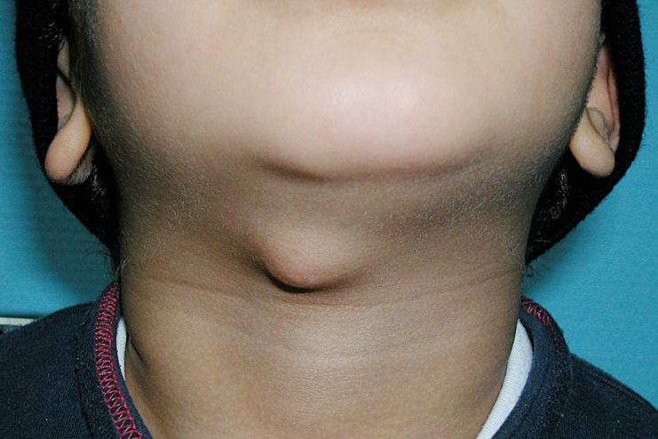 All You Need To Know About Chin Lump