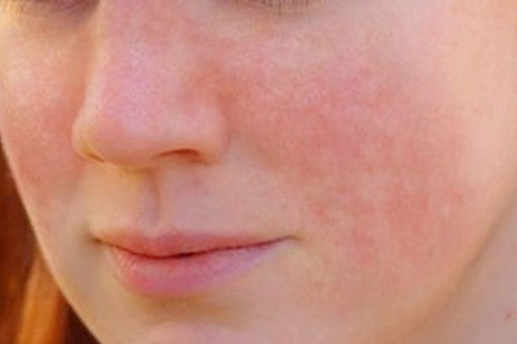 Types And Causes For Lupus Rash