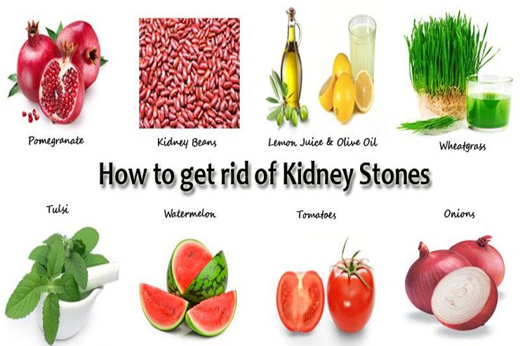 kidney stone removal naturally