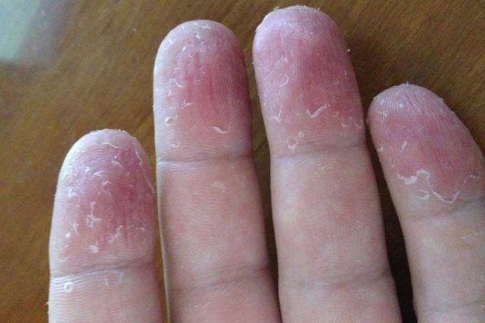 Cure For Fingertips Peeling Get Rid Of The Issue