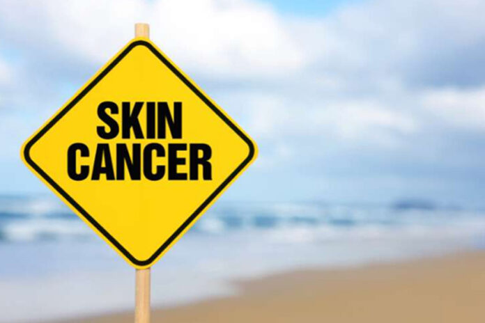 5-Early-Signs-of-Skin-Cancer