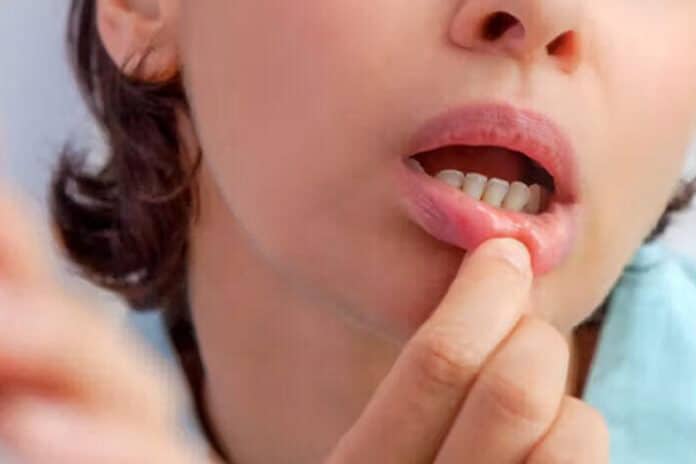 Causes-of-Blood-Blister-in-Mouth