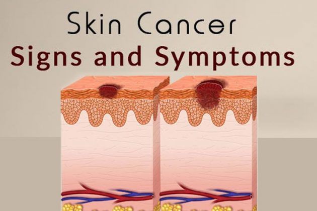 Early Signs Of Skin Cancer Kinds Of Skin Cancer