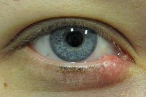 How to Get Rid of A Stye