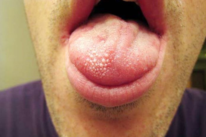 lie-bumps-causes-symptoms-treatment-and-prevention