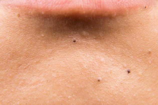 how-to-get-rid-of-black-spots-on-skin