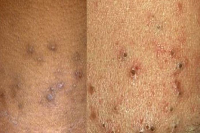 how-to-get-rid-of-black-spots-on-skin