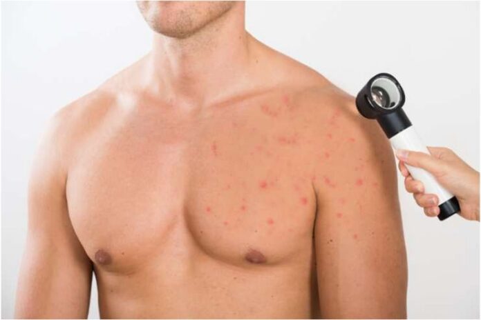 Chest Acne Causes Treatment