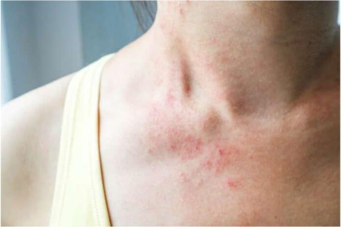 How to Treat a Rash on the Neck