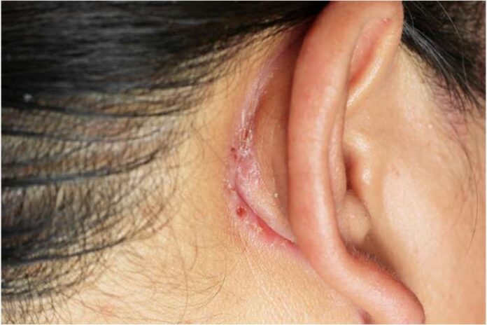 How to Get Rid of Lump Behind Ear