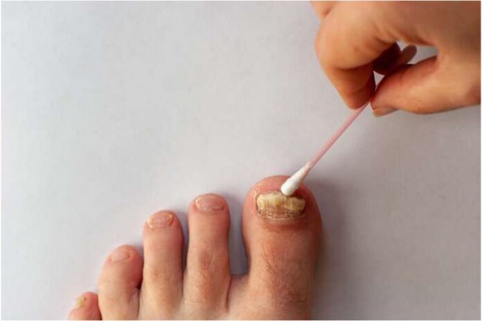 How to Remove Dead Toenails