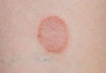 Early Signs Of Skin Cancer | Kinds Of Skin Cancer