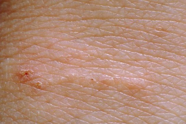 How To Treat And Prevent Scabies In Humans 