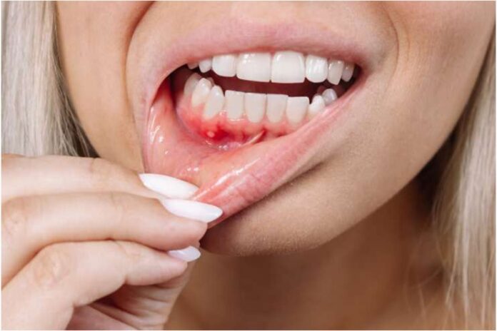 How To Deal With My Bleeding Gums