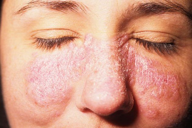 types-and-causes-for-lupus-rash