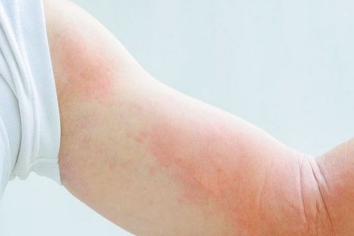 types-and-causes-for-lupus-rash