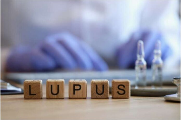 Lupus Rash Treatment