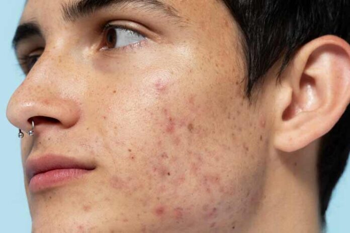 26-Simple-Ways-to-Treat-Cystic-Acne