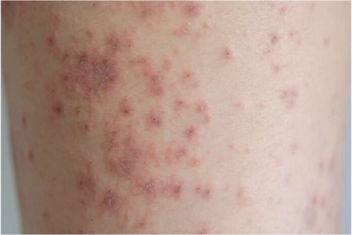 Heat Rash Causes Symptoms