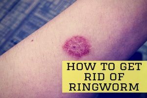 How To Get Rid of Ringworms? 25 Effective Home Remedies To Look Into