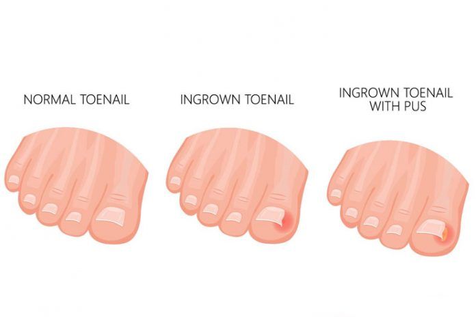 16 Ingrown Toenail Removal Hacks That Will Help You Get Rid of it ...