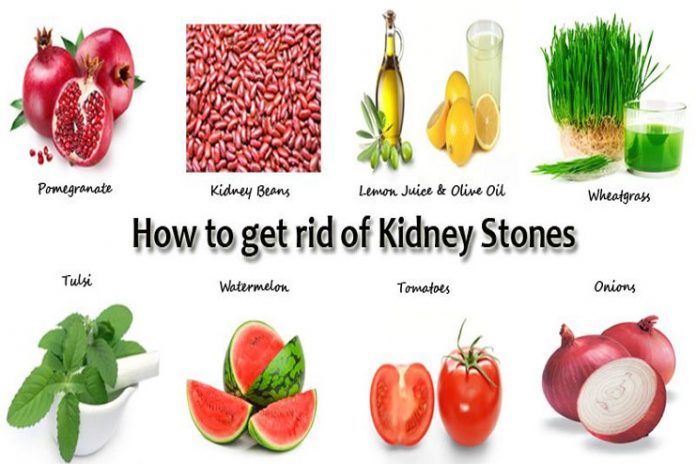 25 Easy Natural Remedies for Kidney Stones That Can Help Flush it Out ...