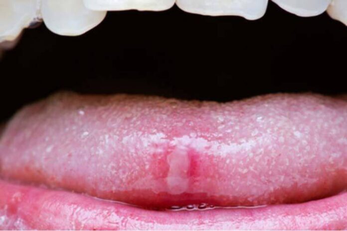 Home Remedies for Tongue Sores