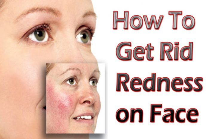 12 Easy and Effective Remedies to Get Rid of Redness Of Face Naturally