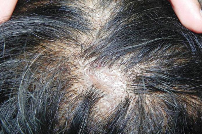 16 Natural Remedies To Say Goodbye To Scabs on Scalp (Without any Pain)