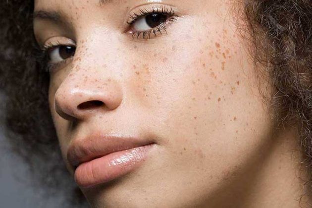 9 Easy And Effective Home Remedies For Freckles Removal At Home 6553