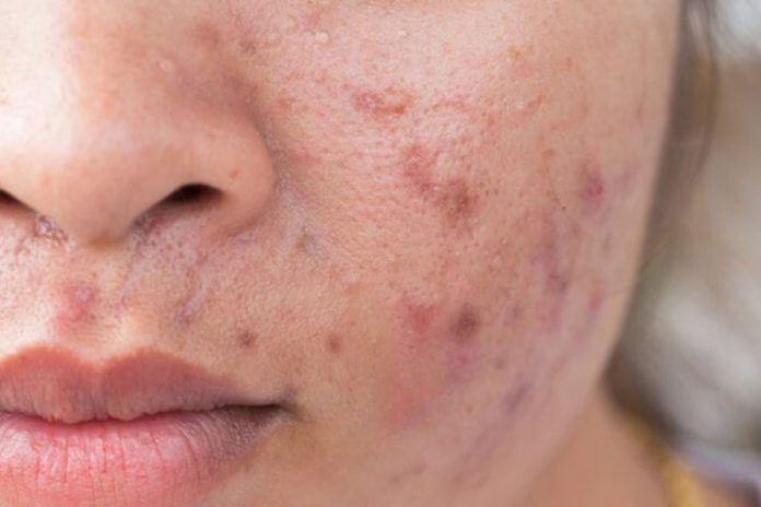 12 Ways To Use Castor Oil For Acne And Better Skin