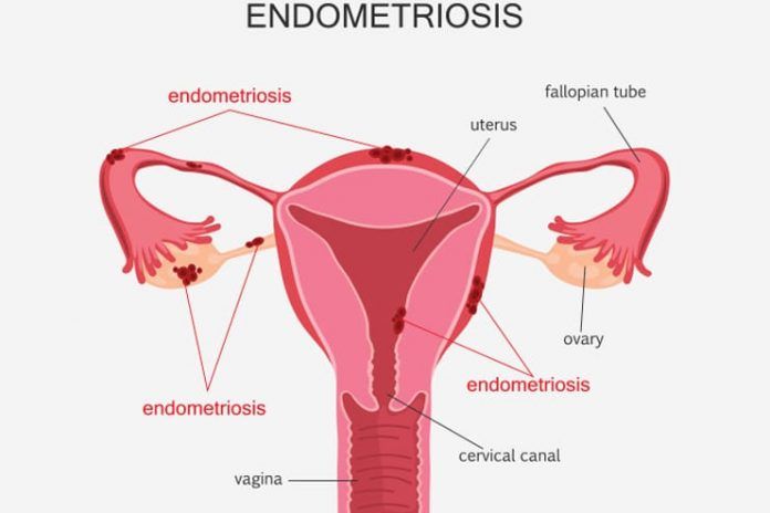 20 Natural Remedies For Endometriosis For Faster Relief