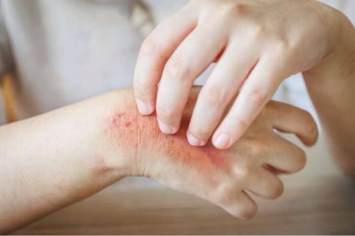 9 Home Remedies for Staph Infection