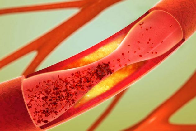 5 Effects Of High Cholesterol You Need To Know Of