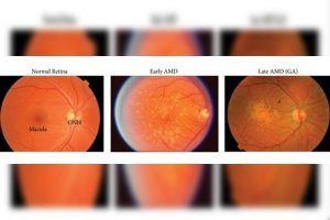 Macular Degeneration Cure – Everything You Possibly Need To Know ...