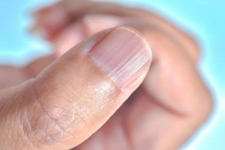 What Fingernails Tell About Your Health 12 Possible Facts 2022