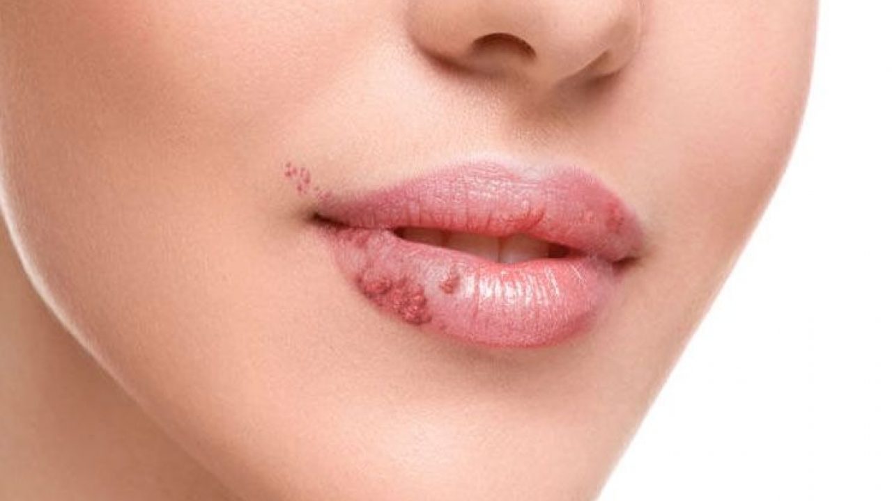 how-to-get-rid-of-fordyce-spots-on-lips-yabibo