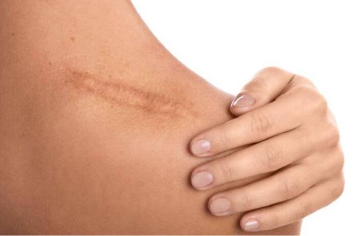 15 Natural Remedies For Old Scars