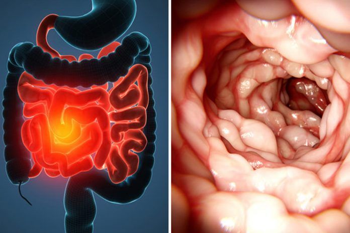 15 Natural Remedies For Crohn’s Disease Cure Things The