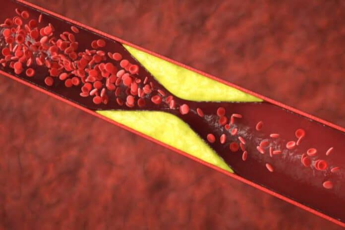 How to Manage Chronic Blood Clotting