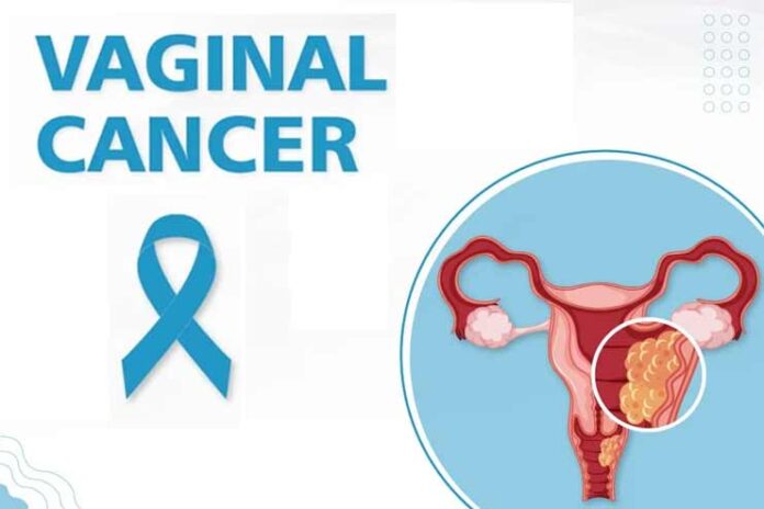 10-Causes-of-Vaginal-Cancer