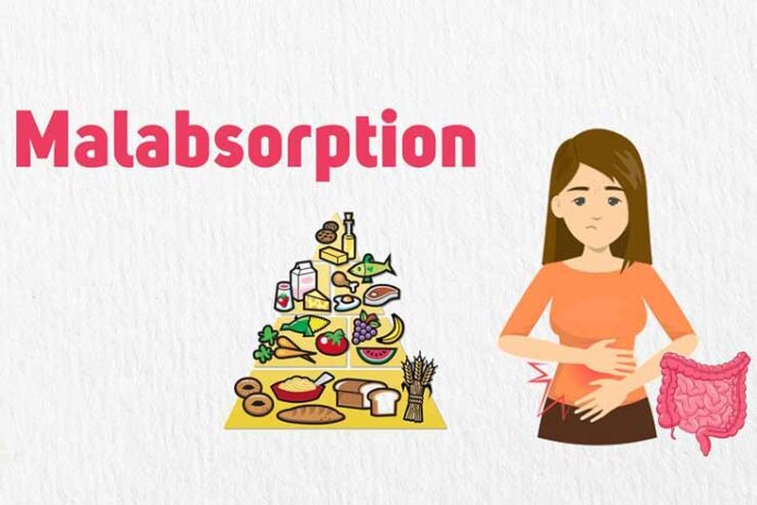 10-Common-Symptoms-of-Malabsorption