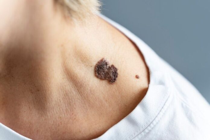 How to Identify Cancerous Moles