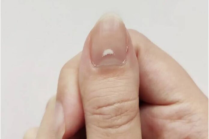 Remove White Spots on Nails