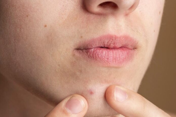 Acne Around the Mouth