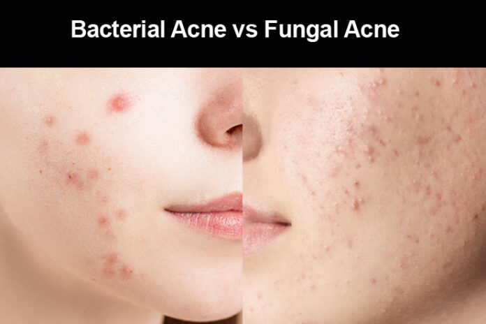 Fungal Acne vs Bacterial Acne