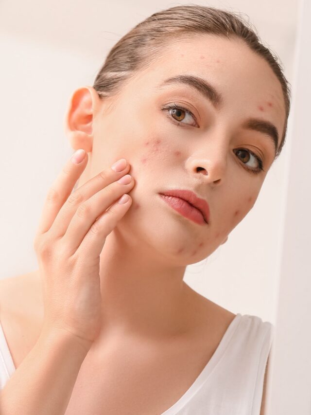 Skincare Mistakes That Make Acne Worse